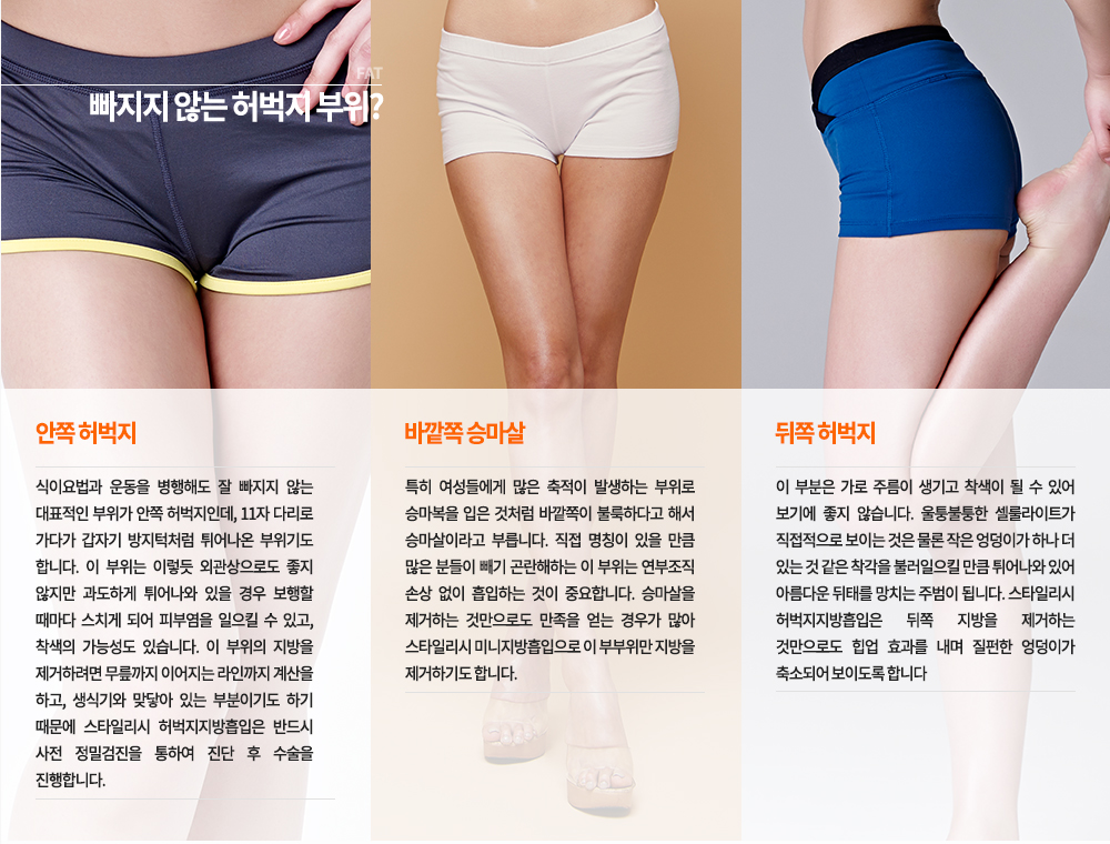 -빠지지 않는 허벅지 부위?
1. 안쪽 허벅지 : 식이요법과 운동을 병행해도 잘 빠지지 않는 대표적인 부위가 안쪽 허벅지인데, 11자 다리로 가다가 갑자기 방지턱처럼 튀어나온 부위기도 합니다. 이 부위는 이렇듯 외관상으로도 좋지 않지만 과도하게 튀어나와 있을 경우 보행할 때마다 스치게 되어 피부염을 일으킬 수 있고, 착색의 가능성도 있습니다. 이 부위의 지방을 제거하려면 무릎까지 이어지는 라인까지 계산을 하고, 생식기와 맞닿아 있는 부분이기도 하기 때문에 스타일리시 허벅지지방흡입은 반드시 사전 정밀검진을 통하여 진단 후 수술을 진행합니다.

2. 바깥쪽 승마살 : 특히 여성들에게 많은 축적이 발생하는 부위로 승마복을 입은 것처럼 바깥쪽이 불룩하다고 해서 승마살이라고 부릅니다. 직접 명칭이 있을 만큼 많은 분들이 빼기 곤란해하는 이 부위는 연부조직 손상 없이 흡입하는 것이 중요합니다. 승마살을 제거하는 것만으로도 만족을 얻는 경우가 많아 스타일리시 미니지방흡입으로 이 부부위만 지방을 제거하기도 합니다.

3. 뒤쪽 허벅지 : 이 부분은 가로 주름이 생기고 착색이 될 수 있어 보기에 좋지 않습니다. 울퉁불퉁한 셀룰라이트가 직접적으로 보이는 것은 물론 작은 엉덩이가 하나 더 있는 것 같은 착각을 불러일으킬 만큼 튀어나와 있어 아름다운 뒤태를 망치는 주범이 됩니다. 스타일리시 허벅지지방흡입은 뒤쪽 지방을 제거하는 것만으로도 힙업 효과를 내며 질펀한 엉덩이가 축소되어 보이도록 합니다.
