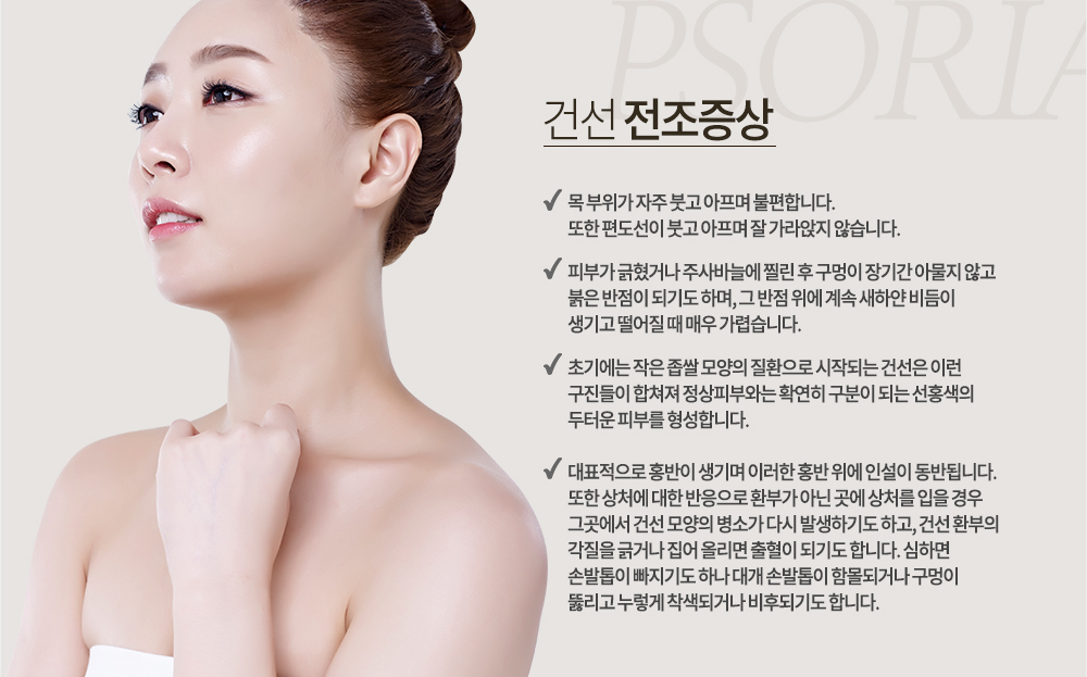 건선 증상
*건선 전조증상
목 부위가 자주 붓고 아프며 불편합니다. 또한 편도선이 붓고 아프며 잘 가라앉지 않습니다.
피부가 긁혔거나 주사바늘에 찔린 후 구멍이 장기간 아물지 않고 붉은 반점이 되기도 하며, 그 반점 위에 계속 새하얀 비듬이 생기고 떨어질 때 매우 가렵습니다.
초기에는 작은 좁쌀 모양의 질환으로 시작되는 건선은 이런 구진들이 합쳐져 정상피부와는 확연히 구분이 되는 선홍색의 두터운 피부를 형성합니다.
대표적으로 홍반이 생기며 이러한 홍반 위에 인설이 동반됩니다. 또한 상처에 대한 반응으로 환부가 아닌 곳에 상처를 입을 경우 그곳에서 건선 모양의 병소가 다시 발생하기도 하고, 건선 환부의 각질을 긁거나 집어 올리면 출혈이 되기도 합니다. 심하면 손발톱이 빠지기도 하나 대개 손발톱이 함몰되거나 구멍이 뚫리고 누렇게 착색되거나 비후되기도 합니다.
