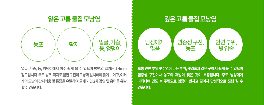 모낭염의 증상과 특징
▶ 얕은 고름 물집 모낭염
얼굴, 가슴, 등, 엉덩이에서 아주 쉽게 볼 수 있으며 병변의 크기는 1-4mm정도입니다. 주로 농포, 딱지로 덮인 구진이 모낭과 일치하여 붉게 보이고, 여러 개의 모낭이 간지러움 및 통증을 유발하여 긁게 되면 2차 감염 및 흉터를 유발 할 수 있습니다.
▶ 깊은 고름 물집 모낭염
보통 안면 부위 콧수염이 나는 부위, 윗입술과 같은 곳에서 쉽게 볼 수 있으며 염증성 구진이나 농포의 재발이 잦은 것이 특징입니다. 주로 남성에게 나타나며 면도 후 주변으로 염증이 번지고 깊어져 만성적으로 진행 될 수 있습니다.
