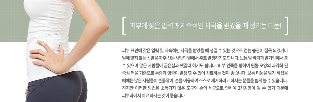 -특징
피부 표면에 잦은 압력 및 지속적인 자극을 받았을 때 생길 수 있는 것으로 걷는 습관이 잘못 되었거나 발에 맞지 않는 신발을 자주 신는 사람의 발에서 주로 발생하기도 합니다. 보통 발 바닥과 발가락에서 볼 수 있으며 많은 사람들이 굳은살과 헷갈려 하기도 합니다. 피부 안쪽을 향하여 원뿔 모양의 과각화 된 중심 핵을 기준으로 통증과 염증이 발생 할 수 있어 치료하는 것이 좋습니다.
보통 티눈을 발견 하셨을 때에는 많은 사람들이 손톱깎이, 손을 이용하여 스스로 제거하려고 하시는 분들을 쉽게 볼 수 있습니다. 하지만 이러한 방법은 소독되지 않은 도구와 손의 세균으로 인하여 2차감염이 될 수 있기 때문에 피부과에서 치료 하시는 것이 좋습니다.
